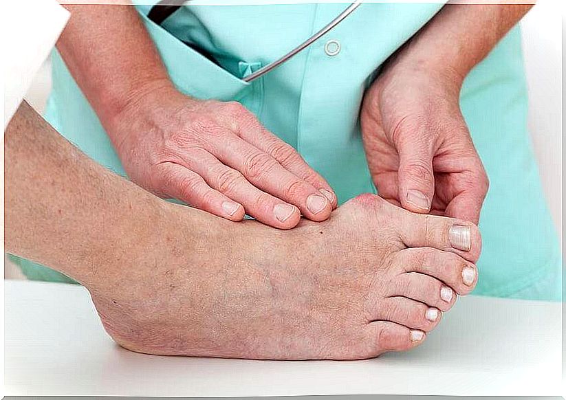 causes of bunions of the foot