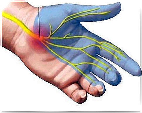 carpal tunnel syndrome