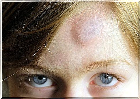 child with bruise on forehead