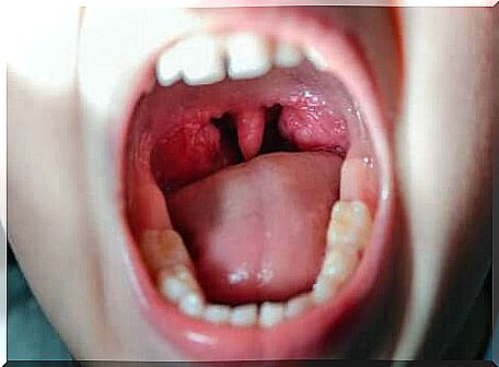 Viral pharyngitis starts in the throat.