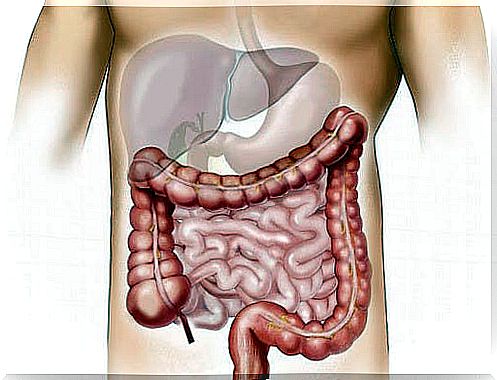 Diagram of inflammatory bowel disease