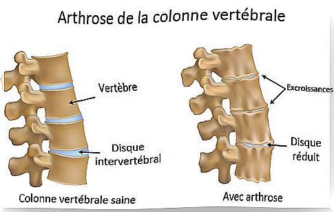 osteoarthritis