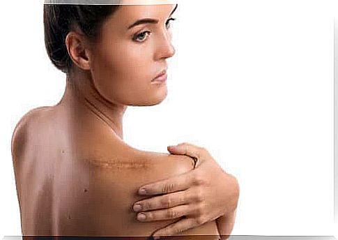 Woman with rotator cuff tear