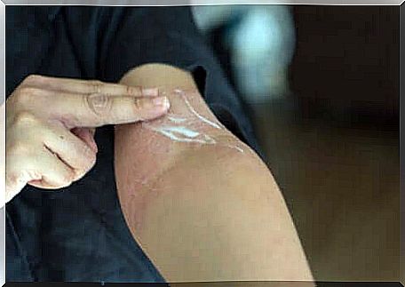 A person applying cream to their arm to combat skin rash.