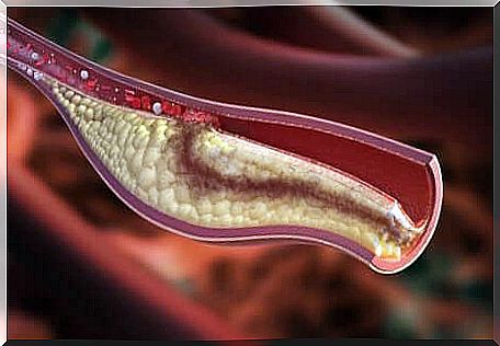 The different types of cholesterol.