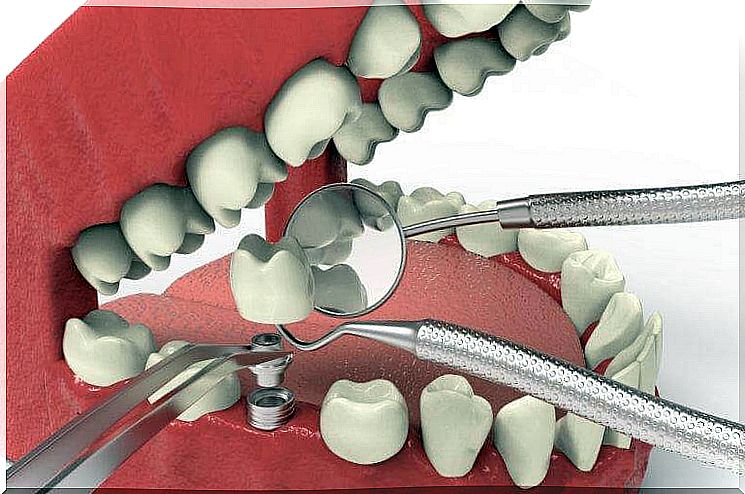 implant in case of dental agenesis