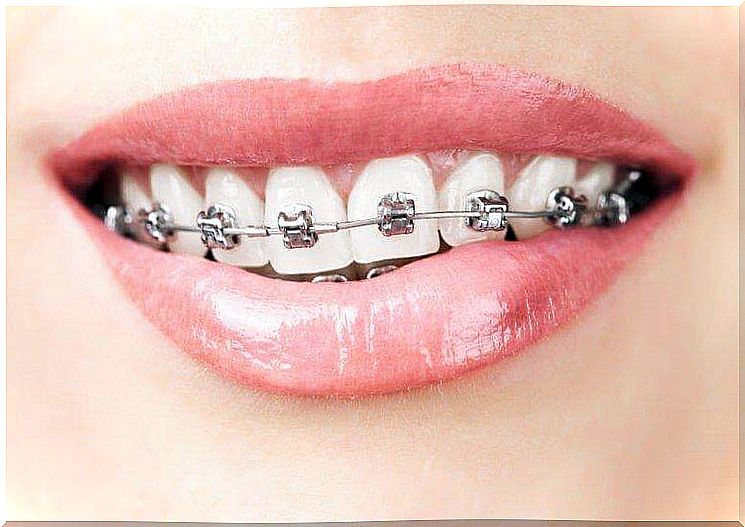 braces and tooth agenesis