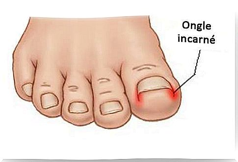 ingrown toenails, one of the main nail diseases