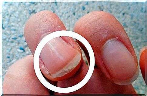 splitting of the nails, one of the main nail diseases