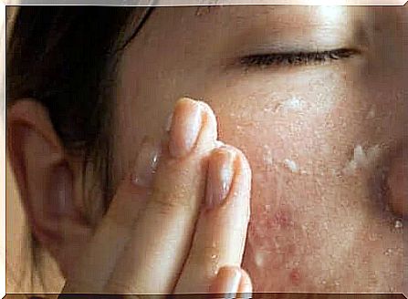 A woman with acne putting on cream.