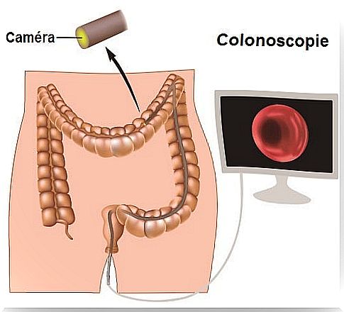 How is colon cancer detected